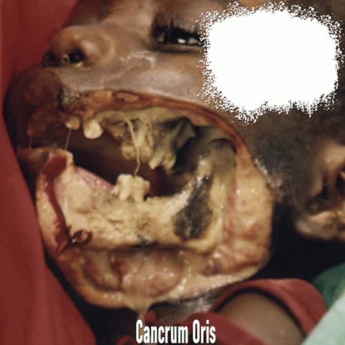 Lymphangiomas : Cancrum Oris Lymphangiomas : Cancrum Oris